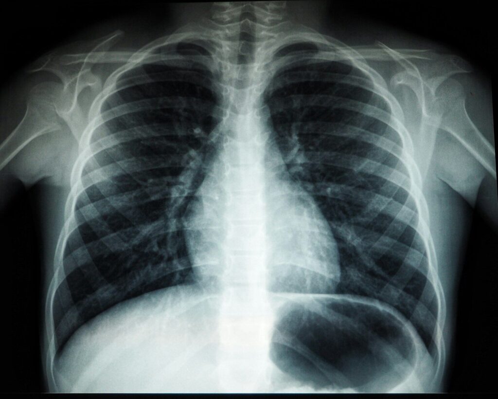 Older men are more likely to die with undiagnosed tuberculosis – study