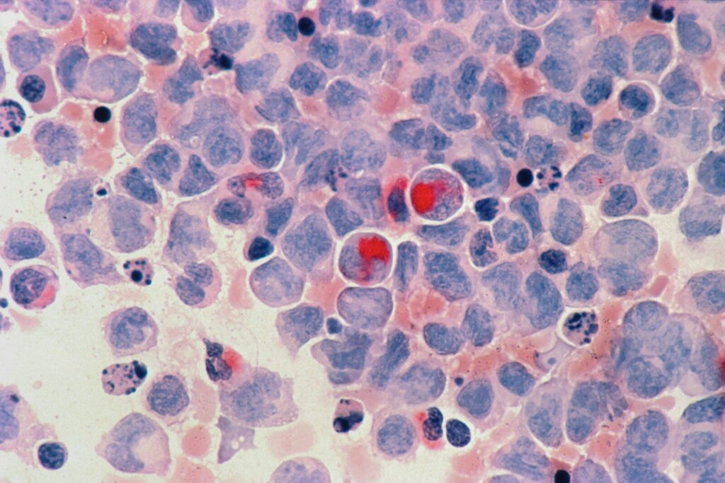 Welsh government to develop 10-year cancer strategy